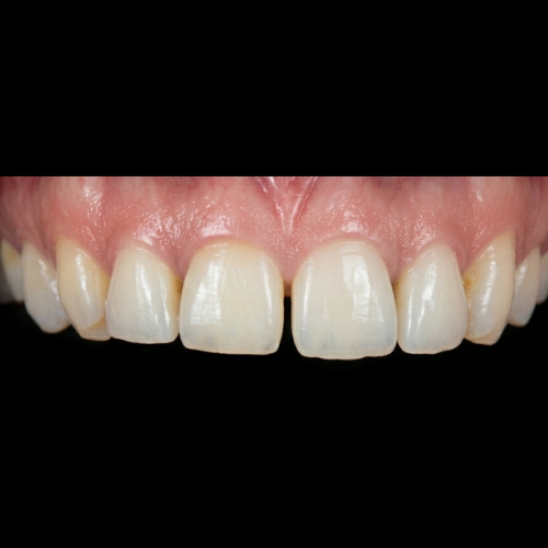 Antes del tratamiento